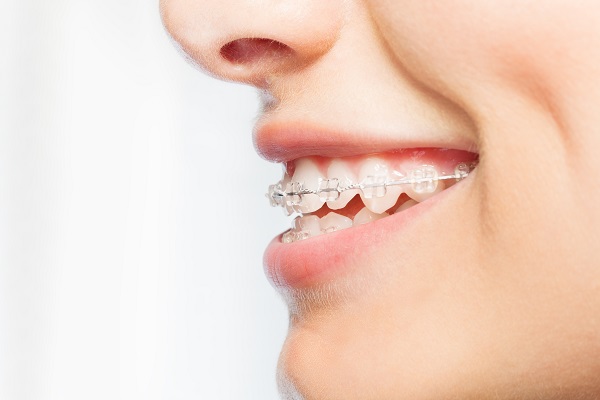 Why You Should Consider Clear Braces